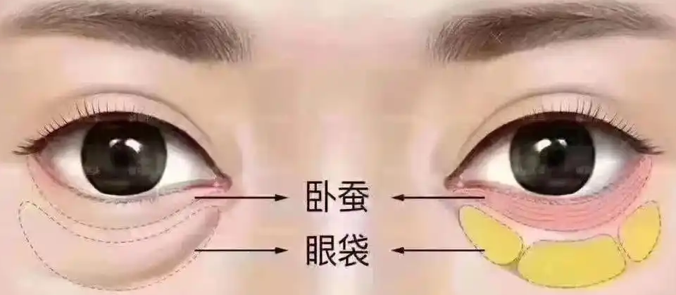 眼袋
