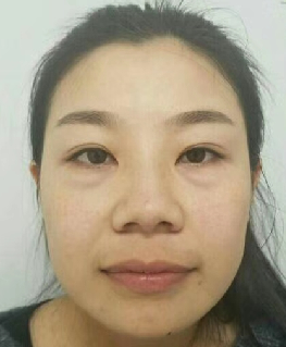 去眼袋手术