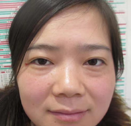 去眼袋手术