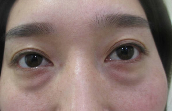 去眼袋手术
