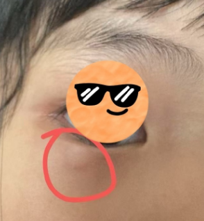去眼袋手术