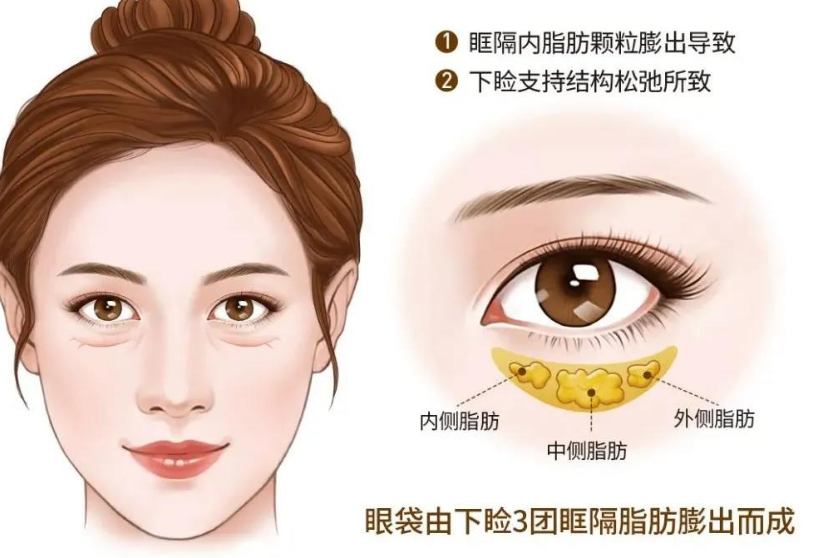 去眼袋手术