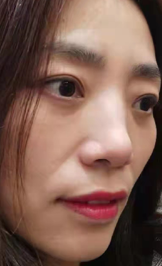 去眼袋手术