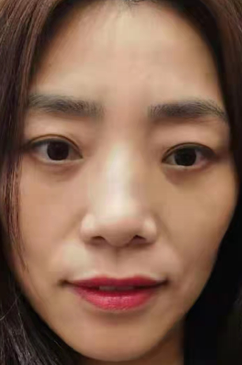去眼袋手术