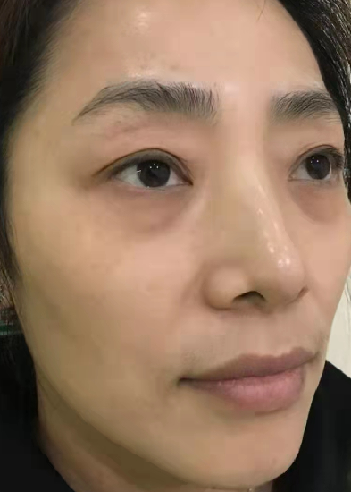 去眼袋手术
