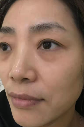 去眼袋手术