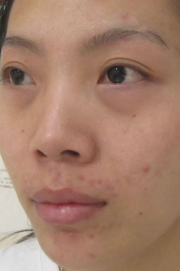 去眼袋手术
