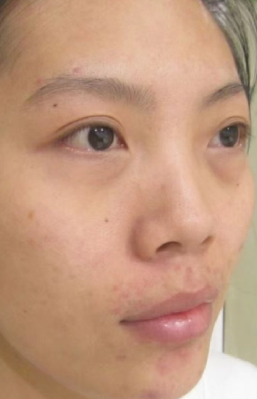 去眼袋手术