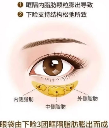 去眼袋手术