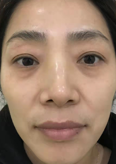 去眼袋手术