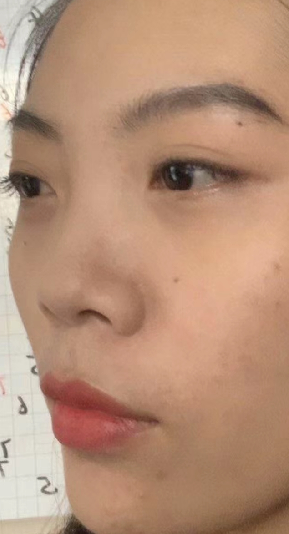 去眼袋手术