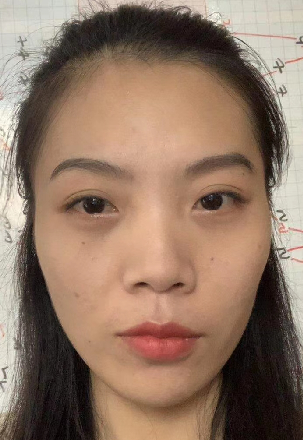 去眼袋手术