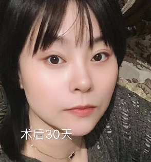 去眼袋手术