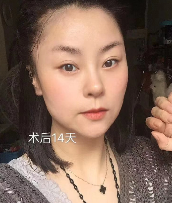 去眼袋手术