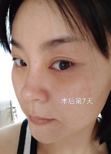 去眼袋手术
