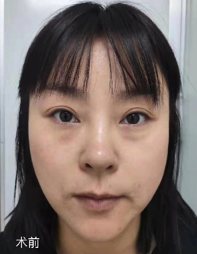 去眼袋手术
