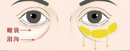 去眼袋手术
