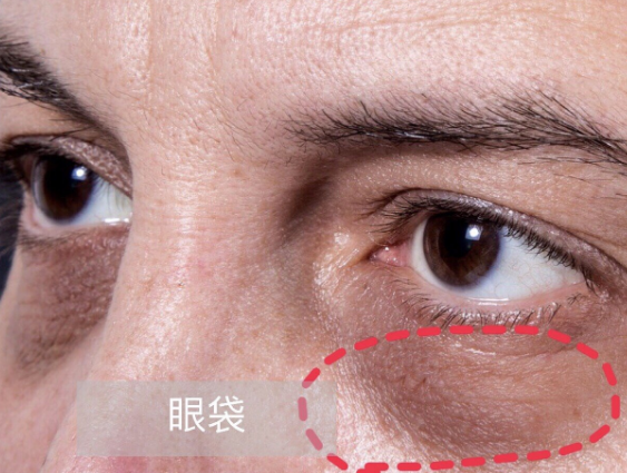 去眼袋手术