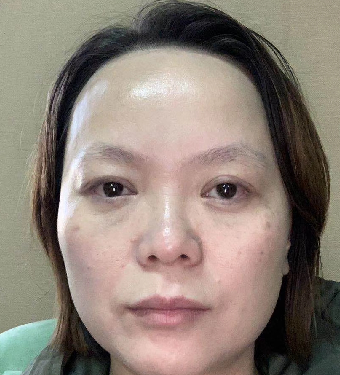 去眼袋手术