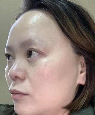 去眼袋手术