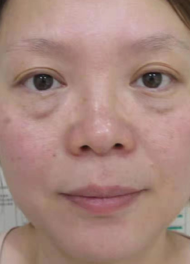 去眼袋手术