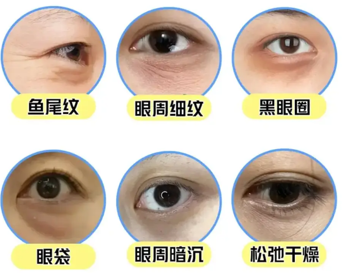 去眼袋手术