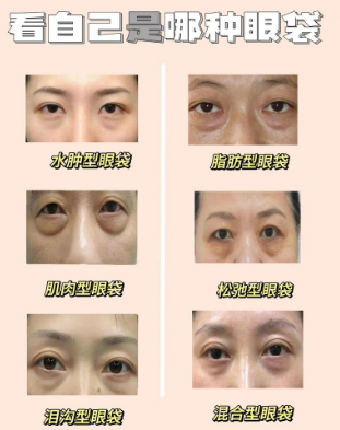 眼袋
