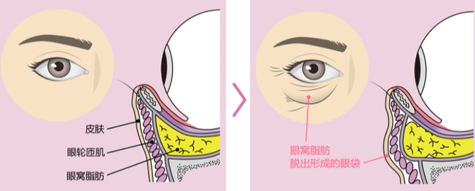 眼袋