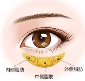 眼袋