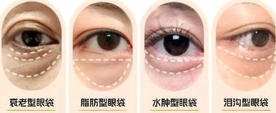 眼袋