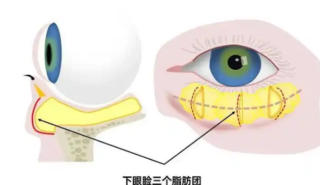 眼袋