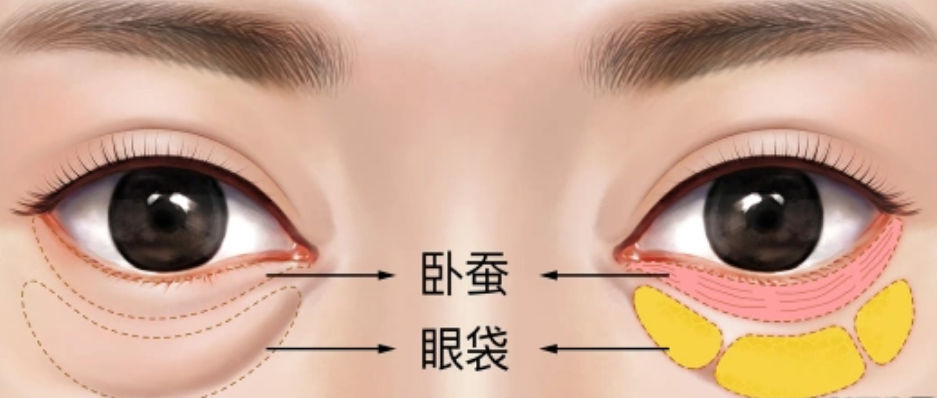 眼袋