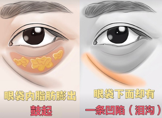 眼袋