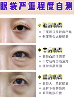 眼袋