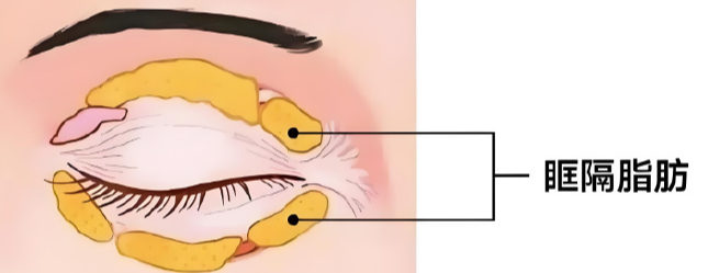 眼袋