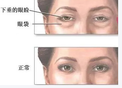眼袋