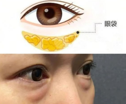 眼袋