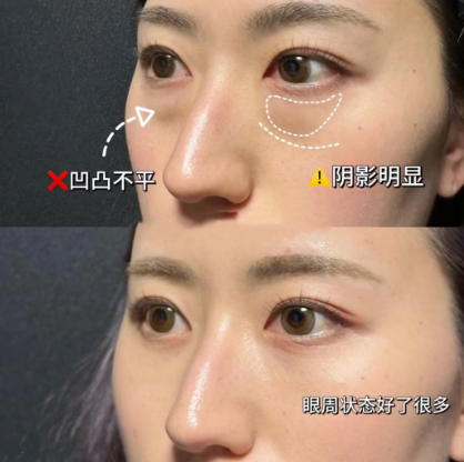眼袋