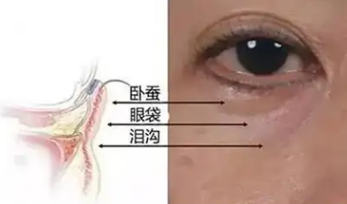 眼袋
