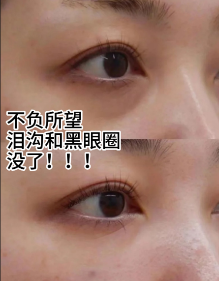 眼袋