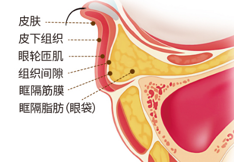 去眼袋手术