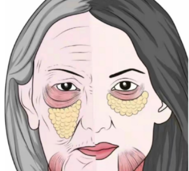 去眼袋手术