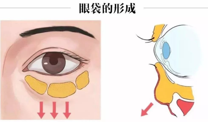 去眼袋手术