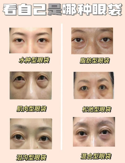 去眼袋手术