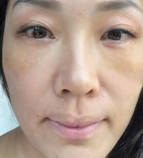 去眼袋手术
