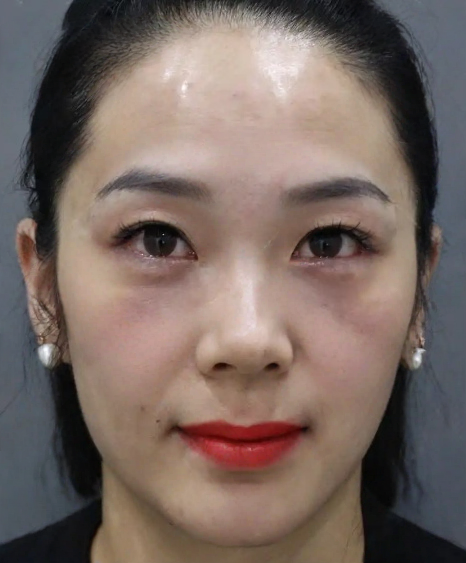 去眼袋手术