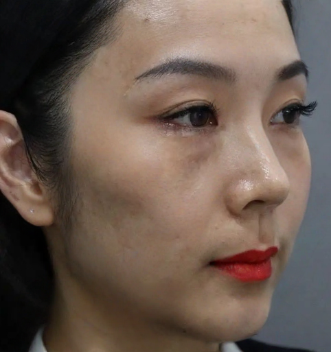 去眼袋手术
