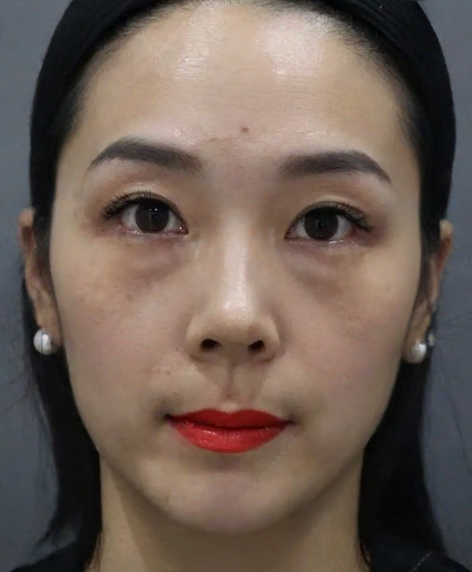 去眼袋手术