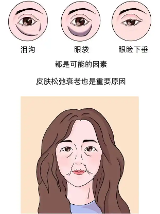 去眼袋手术