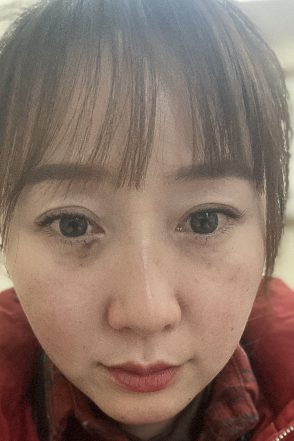 去眼袋手术